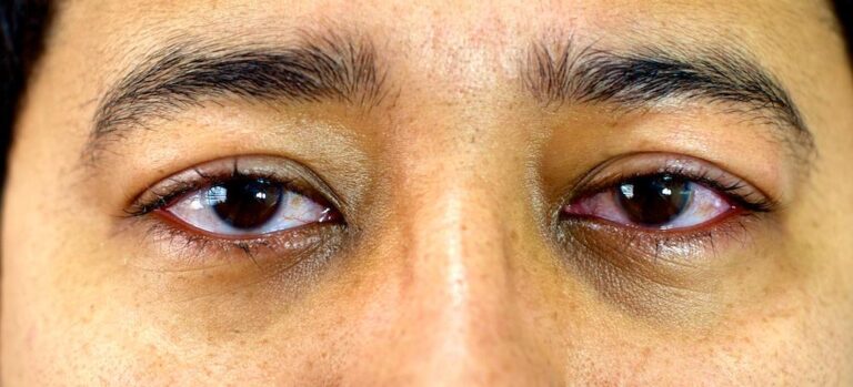 Qual a diferença entre miopia, hipermetropia e astigmatismo?
